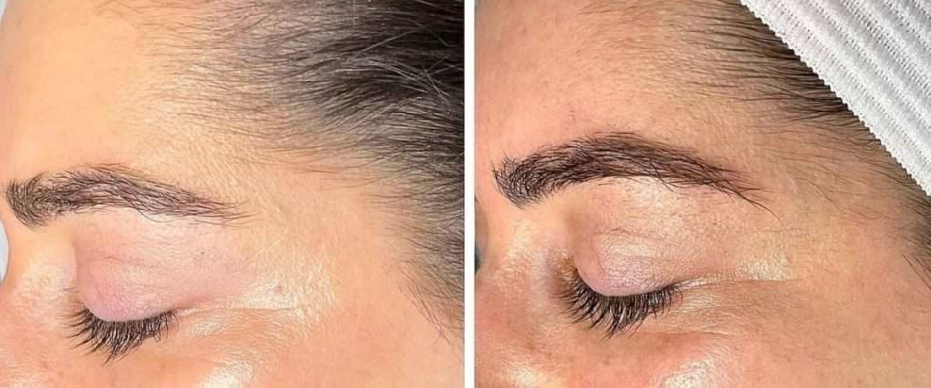 Enhancing Skin Texture and Tone: The Benefits and Treatment Process of Hydrafacials