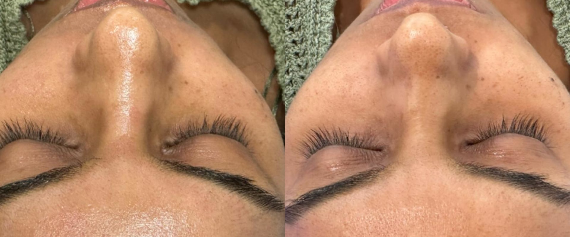 Maintaining Hydrafacial Results at Home