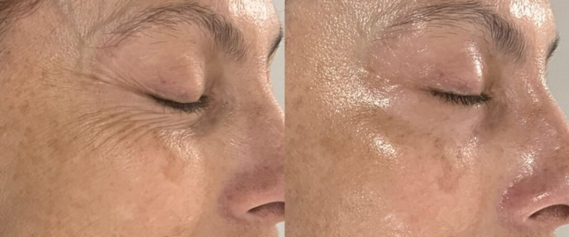 Understanding the Benefits of Increased Circulation and Collagen Production for Overall Skin Rejuvenation