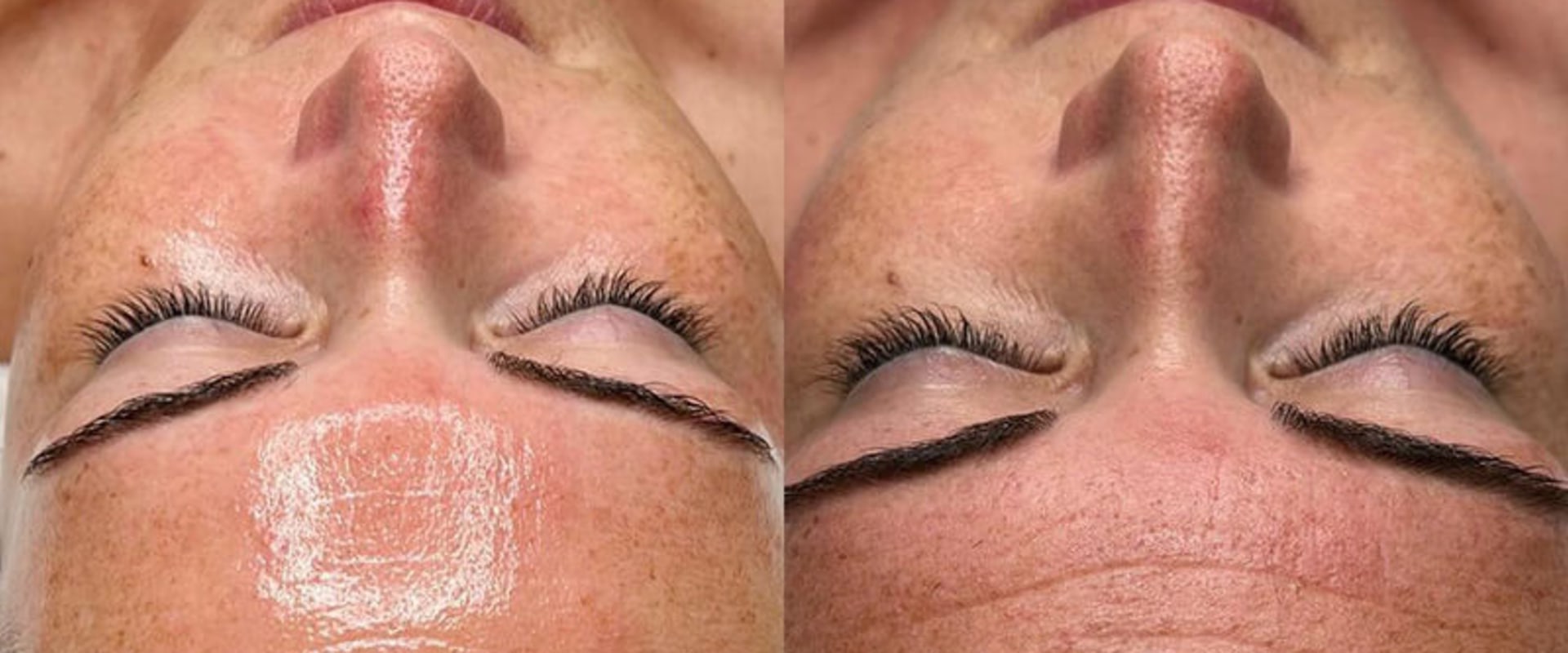Showcasing the Benefits and Results of HydraFacials
