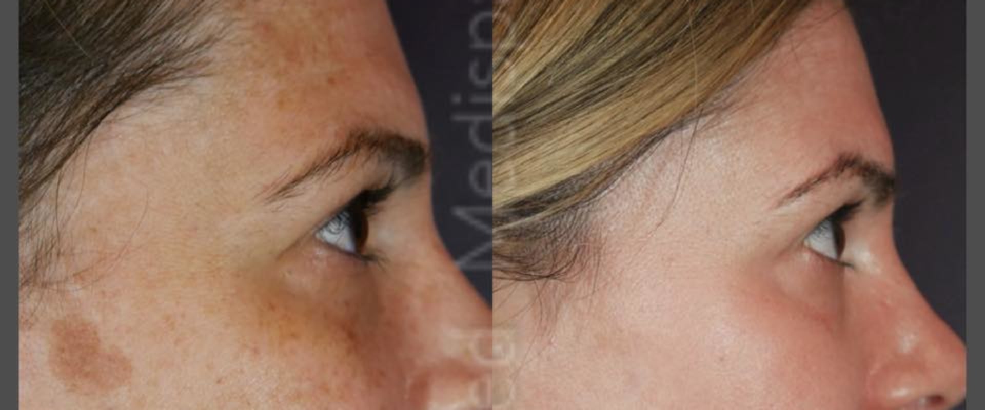 Understanding Sun Damage and Hyperpigmentation for Better Skin Health