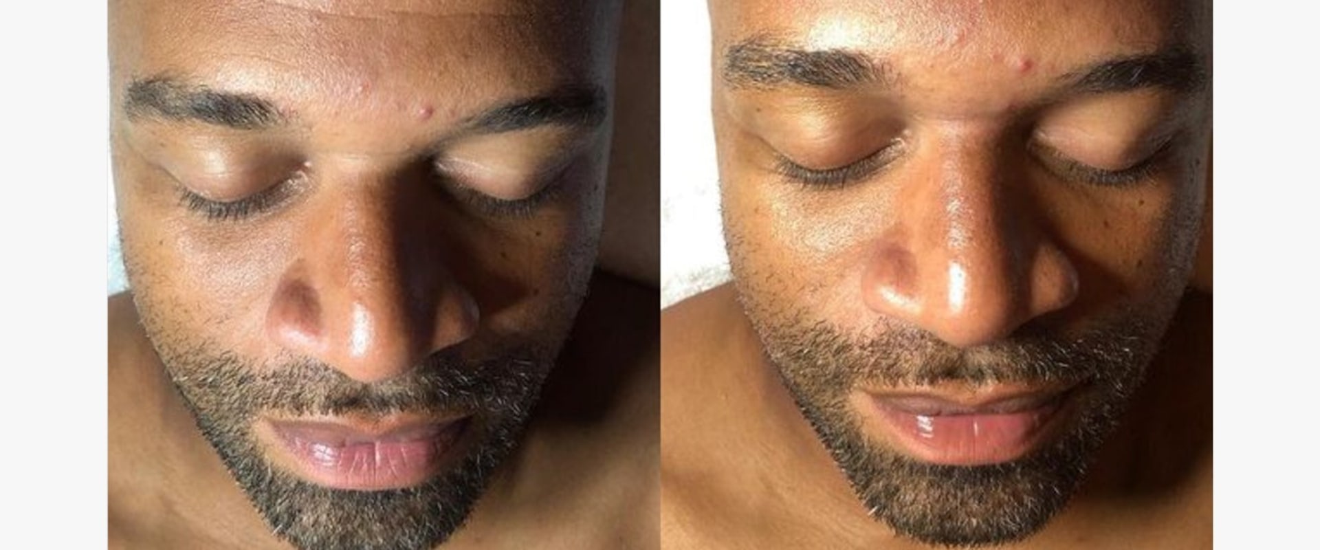 All You Need to Know About HydraFacials: Benefits, Treatment Process, Reviews, and More