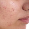 Understanding Acne and Blemishes