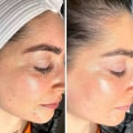 Enhancing Skin Texture and Tone: The Benefits and Treatment Process of Hydrafacials