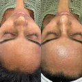 Maintaining Hydrafacial Results at Home
