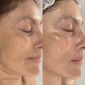 Understanding the Benefits of Increased Circulation and Collagen Production for Overall Skin Rejuvenation