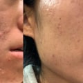 The Benefits of Hydrafacials for Congested Pores and Blackheads