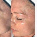 Pros and Cons of DIY vs. Professional Hydrafacial