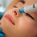 Deep Cleansing with Vortex Suction: The Ultimate Guide to Hydrafacials