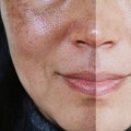 A Comprehensive Look at Hydrafacial Benefits for Skin Health