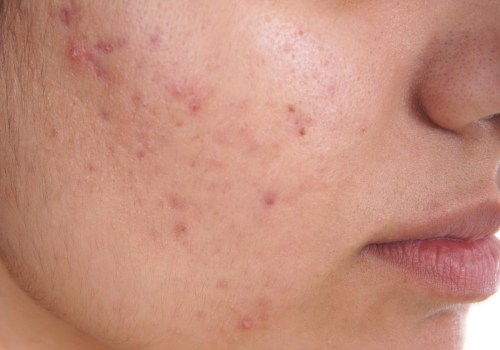 Understanding Acne and Blemishes