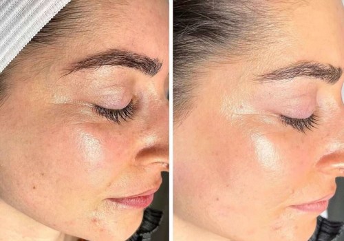 Enhancing Skin Texture and Tone: The Benefits and Treatment Process of Hydrafacials