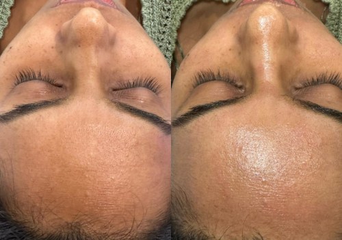 Maintaining Hydrafacial Results at Home