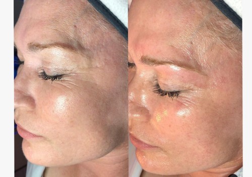 The Cost of a Hydrafacial: What's Included and How It Affects Your Wallet
