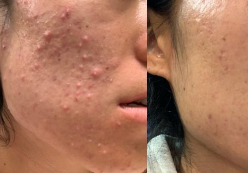 The Benefits of Hydrafacials for Congested Pores and Blackheads