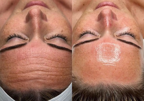 Showcasing the Benefits and Results of HydraFacials