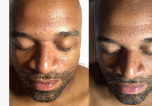 Understanding the Benefits of Hydrafacial Treatments